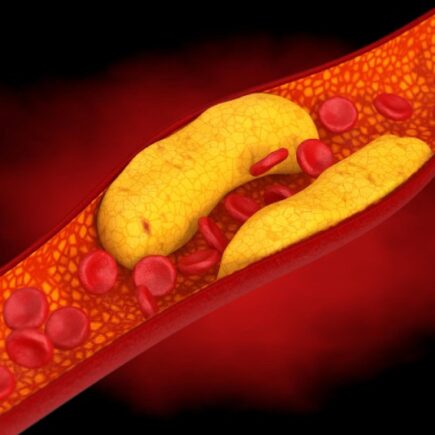 zvýšený cholesterol