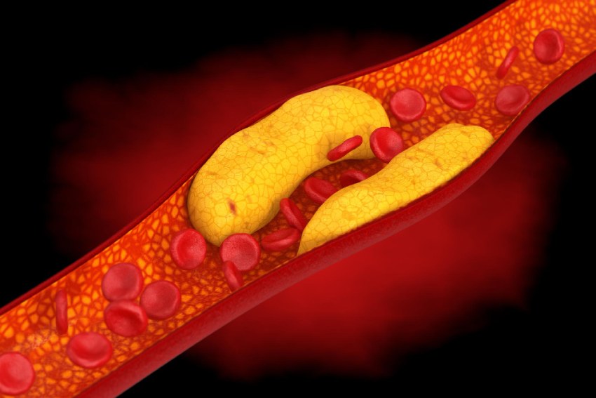 zvýšený cholesterol